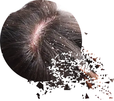 При любом виде перхоти