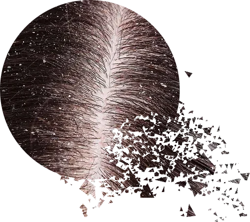 При любом виде перхоти