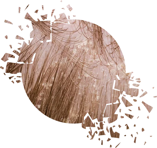 При любом виде перхоти